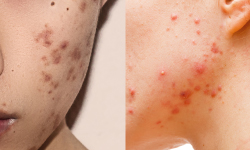 Are pimples and Acne the same?