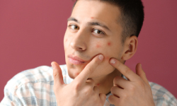 Avoiding-squeezing-the-pimples